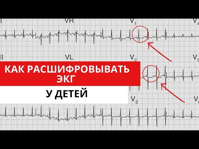 ЭКГ У ДЕТЕЙ. Особенности анализа ЭКГ. Отличие от взрослой ЭКГ.