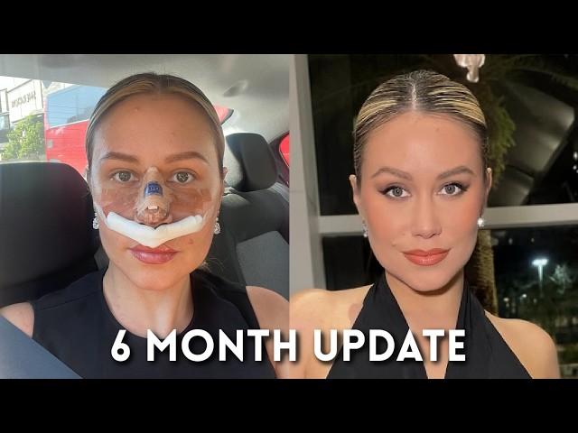 Rhinoplasty Healing Journey – 6 Month Post-Op Update