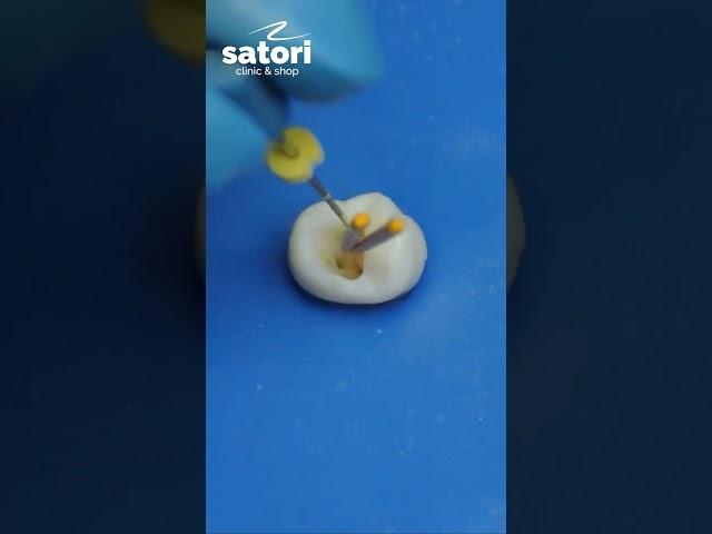 Treatment and filling of tooth canals.