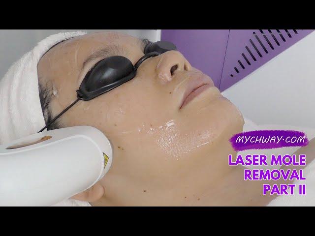 Laser Hair Removal Diode Laser Hair Removal 808nm Laser Painless -myChway GX002 Part II Face