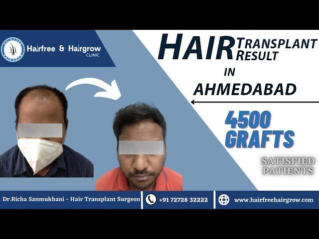 4500 grafts hair transplant || Cost of hair transplant in Gujrat || best hair transplant results