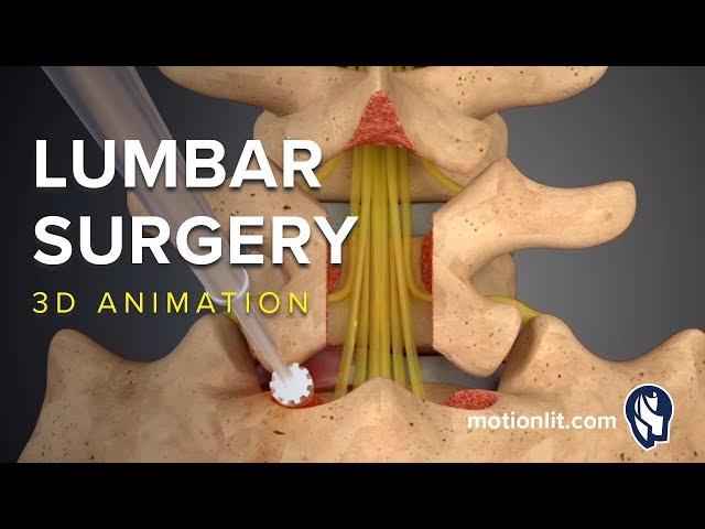 Lumbar Surgery - Laminectomy - 3D Medical Animation