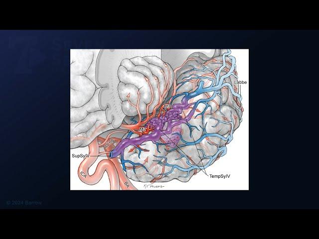 Resection of a Temporal Sylvian Arteriovenous Malformation in a Child