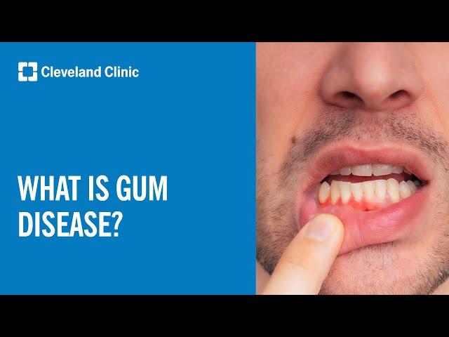 What Is Gum Disease?