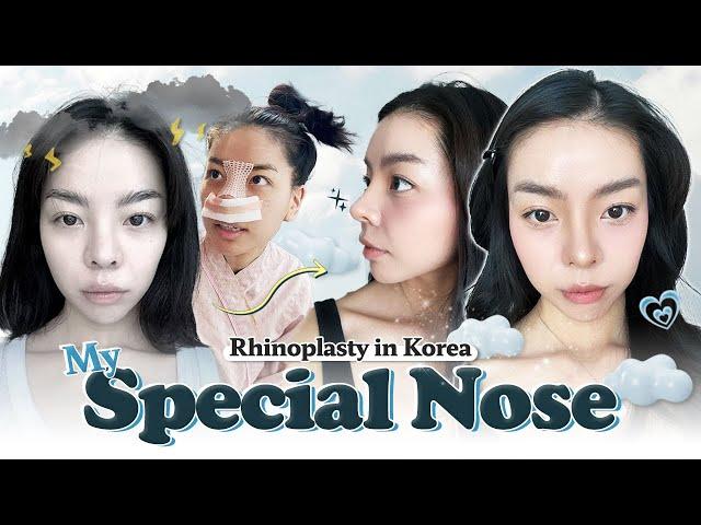 I got a new nose in Korea and I LOVE it! | Nana's rhinoplasty at Braun PART 1 