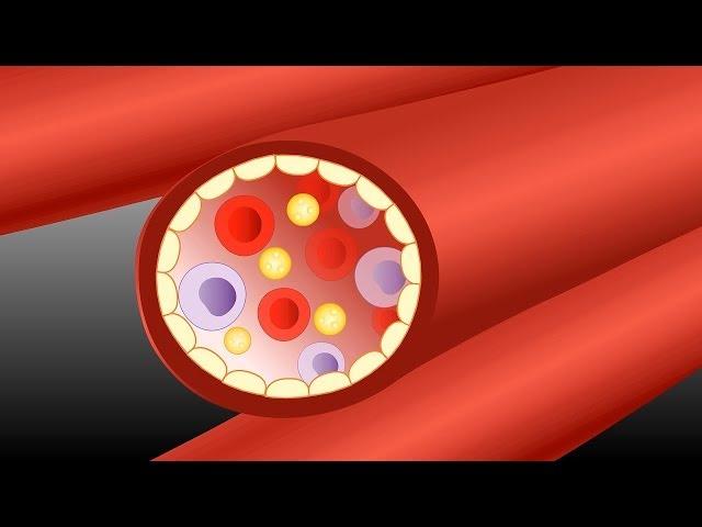 Atheroma in the artery