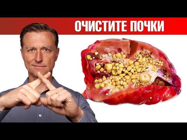 Очищение почек от оксалатов. Профилактика камней в почках 