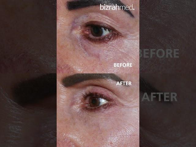 Blepharoplasty (Eyebags Removal): Before and After Results  | Bizrahmed Center 