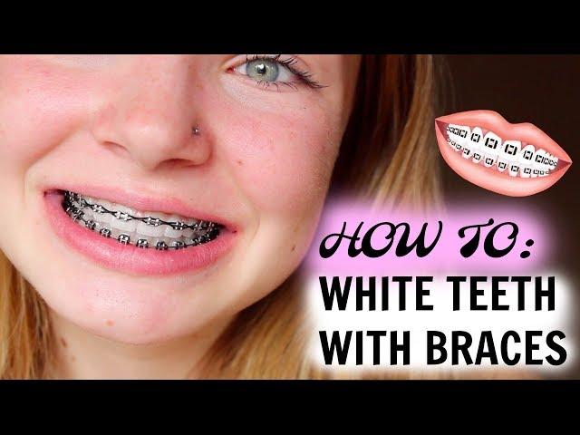 HOW I MAINTAIN WHITE TEETH WITH BRACES