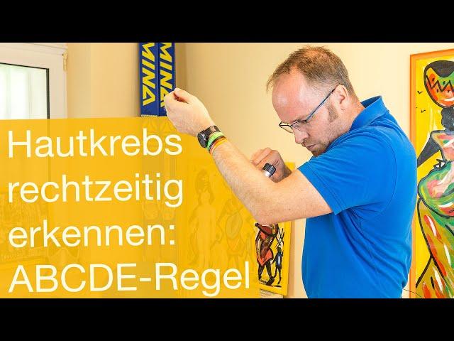 Hautkrebs rechtzeitig erkennen  ABCDE-Regel