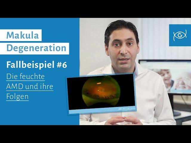 Augenerkrankung Makula Degeneration | Fallbeispiel | Feuchte AMD und ihre Folgen