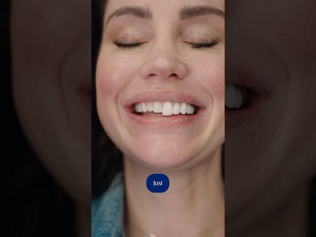 VENEER TRY ON  | Smile Texas #smiledesign #veneers #porcelainveneers #dentist #dentalveneers