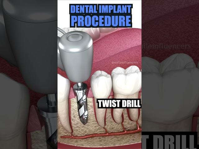 Tooth Implant Process