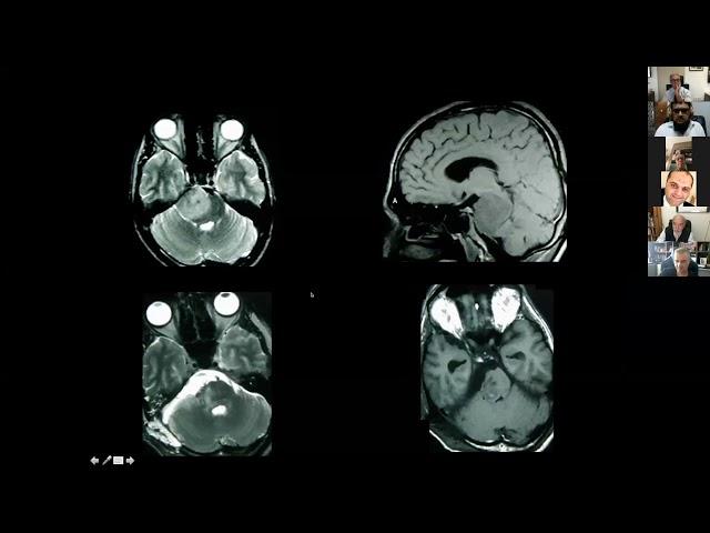 Versatility of the Lateral Supracerebellar Approach | Neurosurgical TV