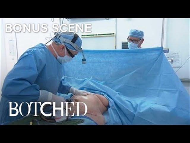 "Botched" Doc Performs Liposuction Surgery | E!