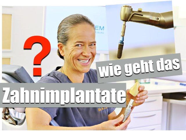 ZAHNIMPLANTATE: genauer ABLAUF, WISSENSWERTES vorab