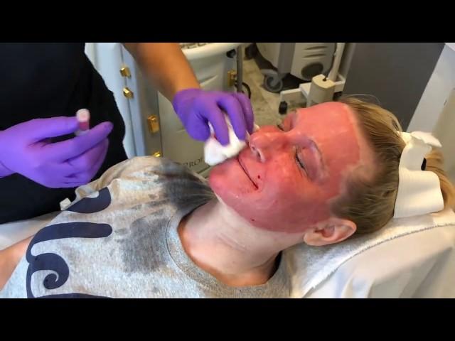 TRL Laser For A Dramatic Skin Rejuvenation