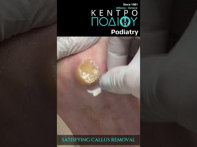 Satisfying Callus Removal|Κέντρο Ποδιού Podiatry|Podiatrist|Podologia|Podologa|Podologos|Feet|Foot