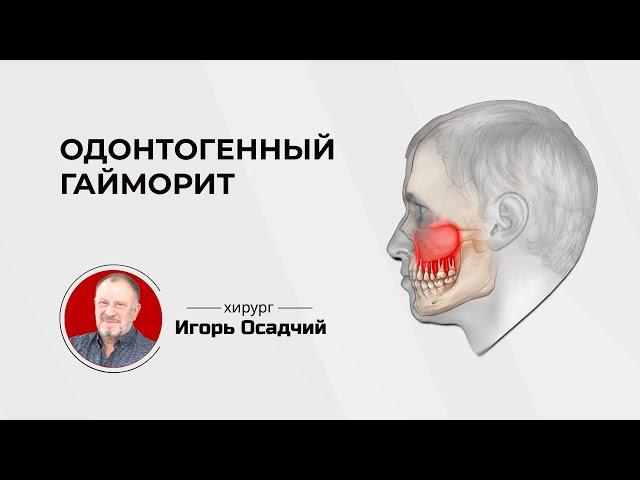 Одонтогенный или стоматологический гайморит