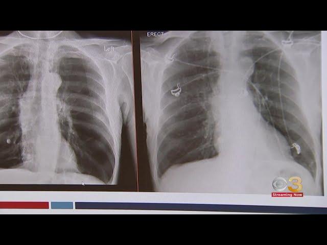 New treatment for people with COPD, emphysema at Penn Medicine