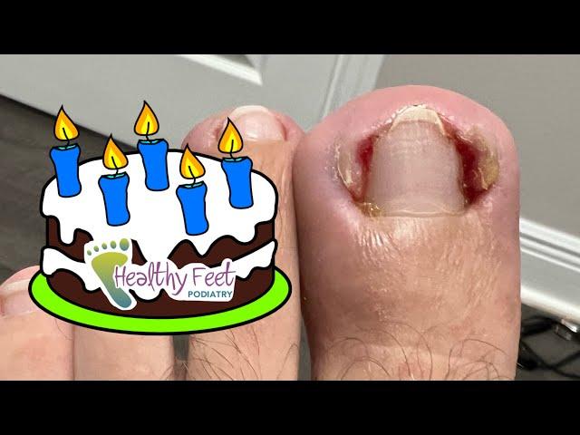 5 YEAR OLD INGROWN NAIL