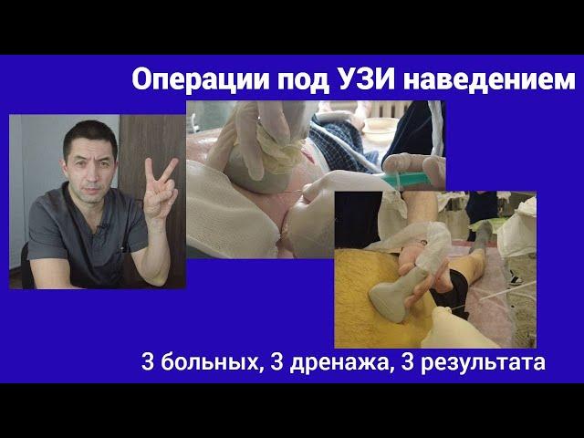 Операции под УЗИ наведением. 3 больных, 3 дренажа, 3 результата.