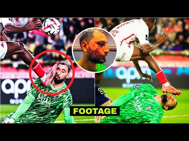 FOOTAGE & UPDATE! Psg Goalkeeper Gianluigi Donnarumma horrible injury vs Monaco