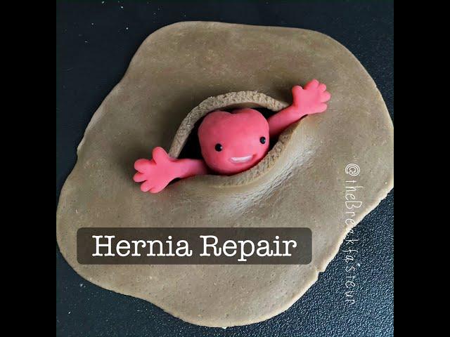 Playdough Surgery - Open Inguinal Hernia Repair (Lichtenstein tension-free mesh repair)