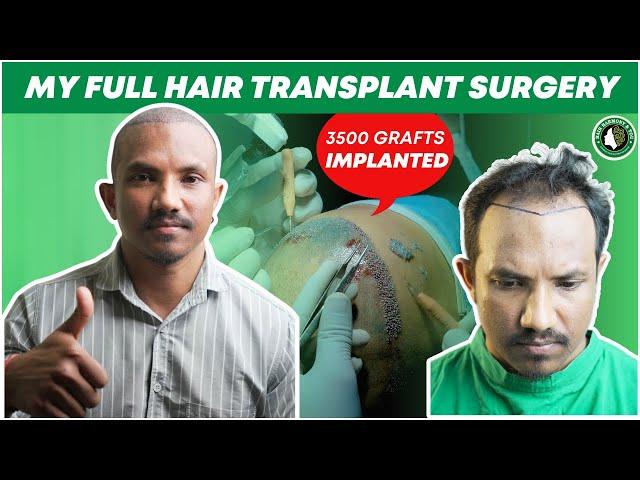 Hair Transplant in Assam | Best Results & Cost of Hair Transplant in Assam