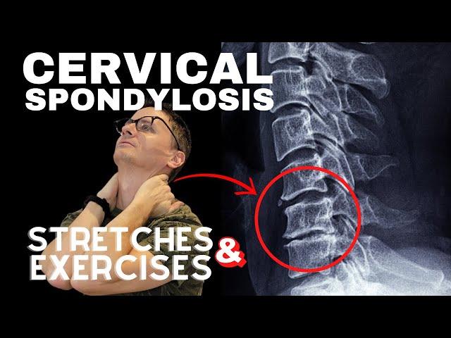 Cervical Spondylosis (Neck Arthritis) Stretches & Exercises | Dr. Jon Saunders