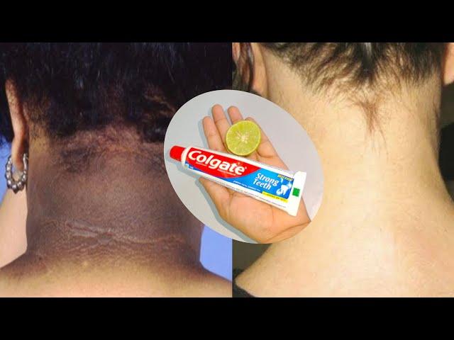 Toothpaste for neck whitening | How to get rid of dark neck in 10 minutes