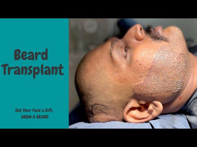 Beard Transplant In India | How to grow dense Beard | Beard Transplant in Mumbai | Navimumbai