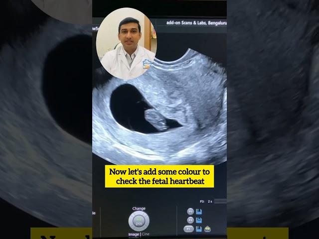 What can you see in an early pregnancy scan?|Dr. Sunil Kumar G S| #earlypregnancy #shorts #pregnant