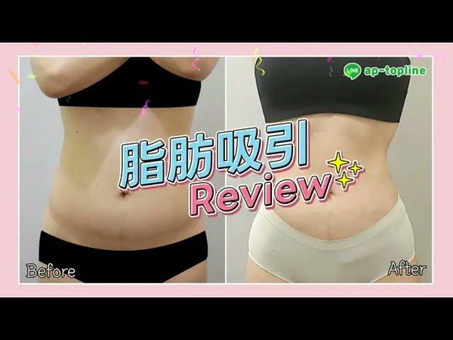 【狎鴎亭トップライン】 大容量脂肪吸引 REVIEW!