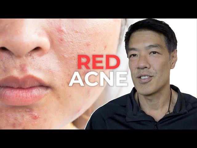 Everything about Red Acne Scars | Dr Davin Lim