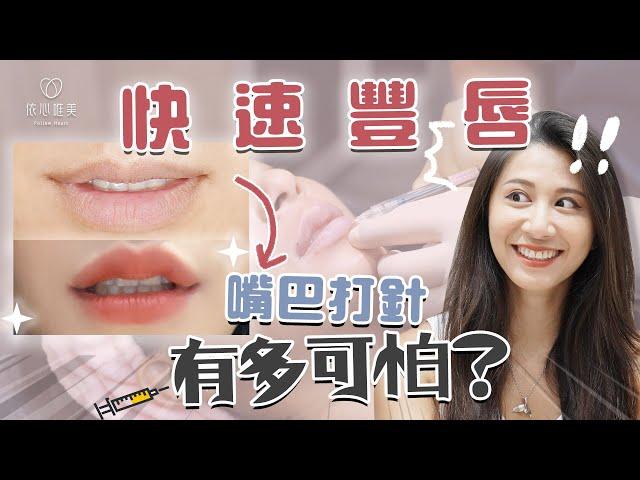 玻尿酸豐唇分享！嘴上打針有多痛？多久自然？效果如何｜依心唯美 謝東穎醫師