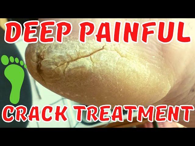 Deep painful crack treatment. Thick skin removal.