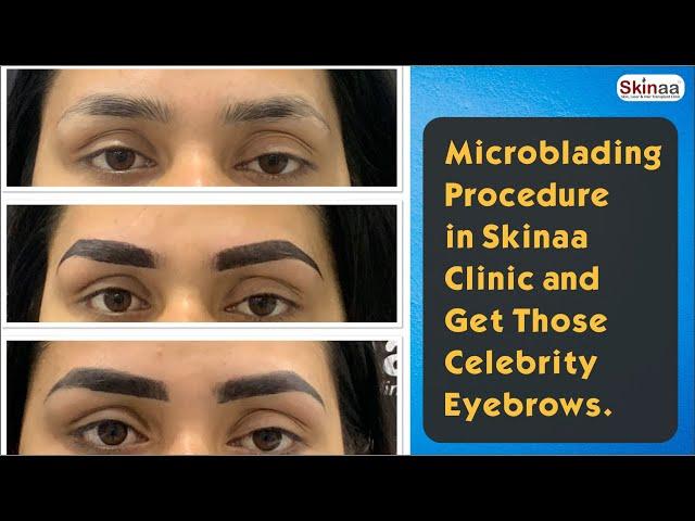 Microblading Procedure in Skinaa Clinic