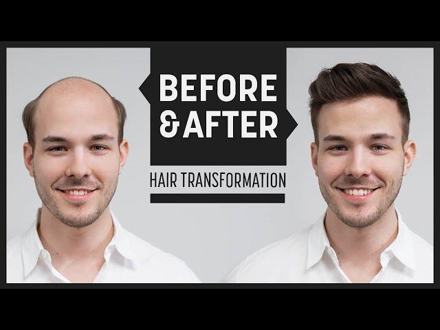 Endlich wieder volles Haar durch Haarersatz | Transformation mit Haarsystem | Hairsystems Heydecke