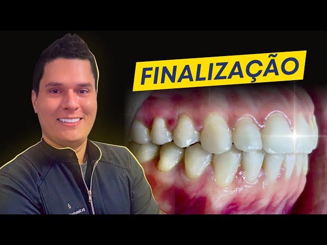 Finalização Ortodôntica : 5 coisas que ATRAPALHAM a boa finalização dos seus casos!