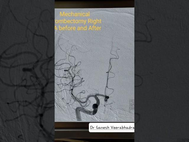 BRAIN STROKE IN GOLDEN HOUR - Mechanical ThrombectomyI BEFORE AFTER lOriginal DSA angiogram clip
