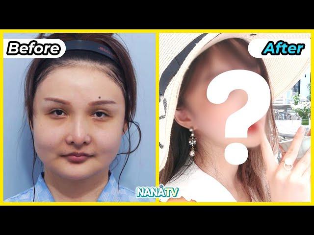  Fantastic Before and After photos from NANA Korea Plastic Surgery | Makeover transformation 