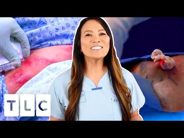 The Top 3 Most Watched Pimple Popping Moments! | Dr. Pimple Popper