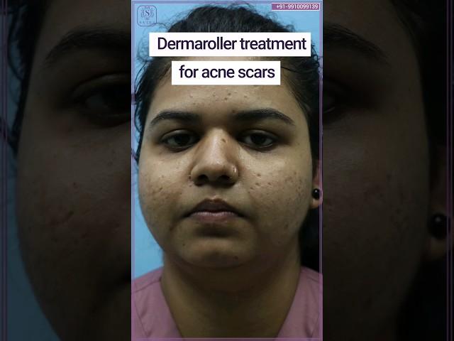 Acne scar treatment | Dermaroller for acne scars | #acnescars #shorts #youtubeshort #acne #skincare