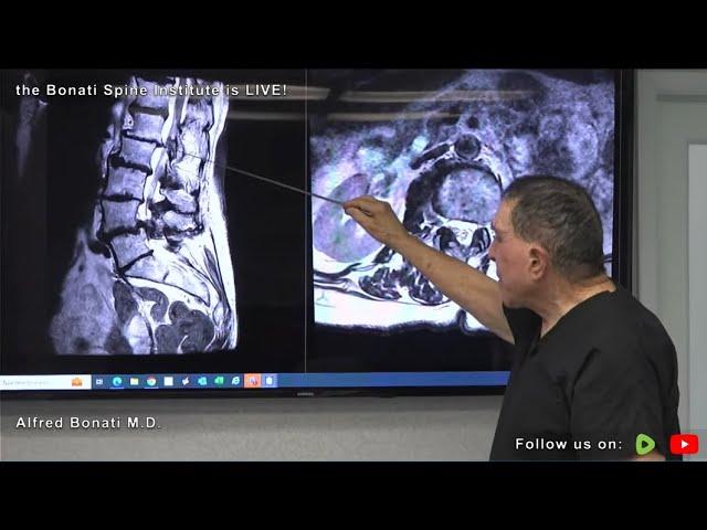 Dr. Alfred Bonati Discusses Neural Foraminal Stenosis