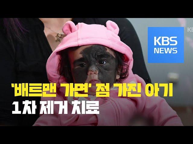 [클릭@지구촌] ‘배트맨 가면’ 무늬 점 가진 아기…“1차 치료 성공적” / KBS뉴스(News)