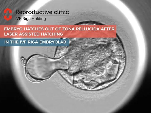 iVF Riga - An embryo hatches out of zona pellucida after Laser Assisted Hatching