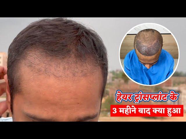 3 Months Completed Hair Transplant Results 9074099148