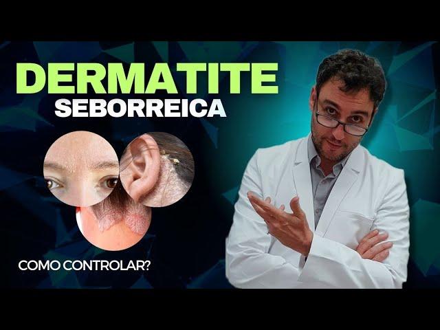 Como controlar a Dermatite Seborreica?