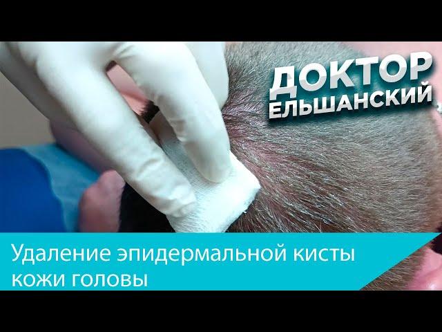 Удаление эпидермальной кисты (атеромы) головы. Removal of atheroma (cyst) of the scalp